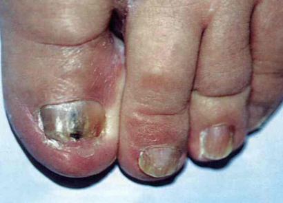 Чернеют ногти на ногах: причины и лечение