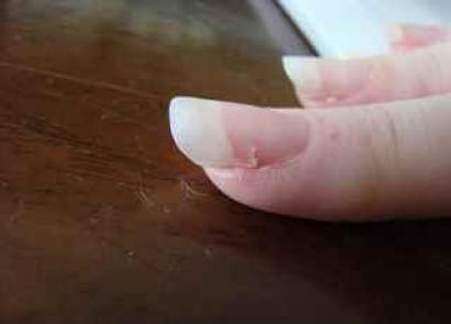 Что делать, если слоятся и ломаются ногти, причины и лечение этой проблемы