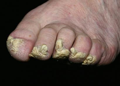 В чем причины и каково лечение утолщения ногтя на большом пальце ноги