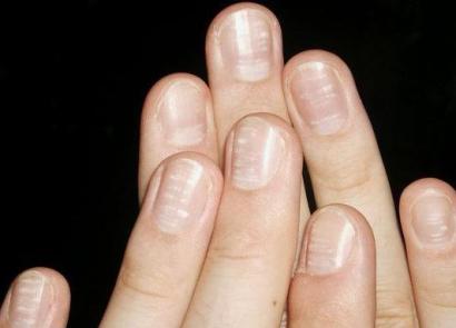 Причины волнистых ногтей на руках